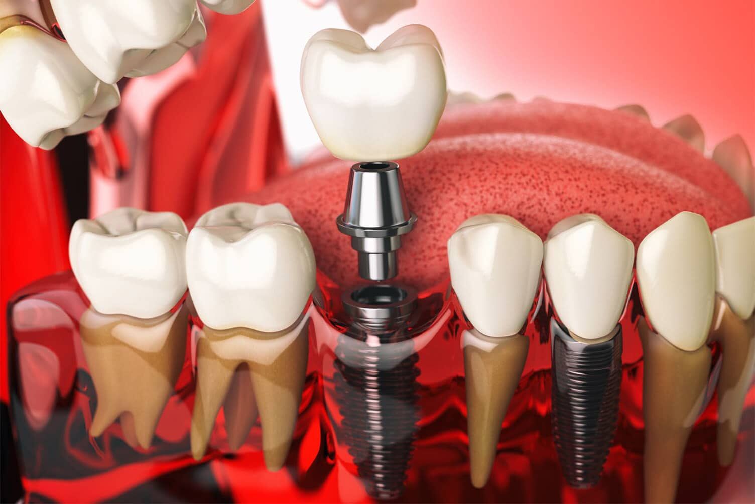 What's new in dental implantology? - Lemont Dental Clinic & Gentle